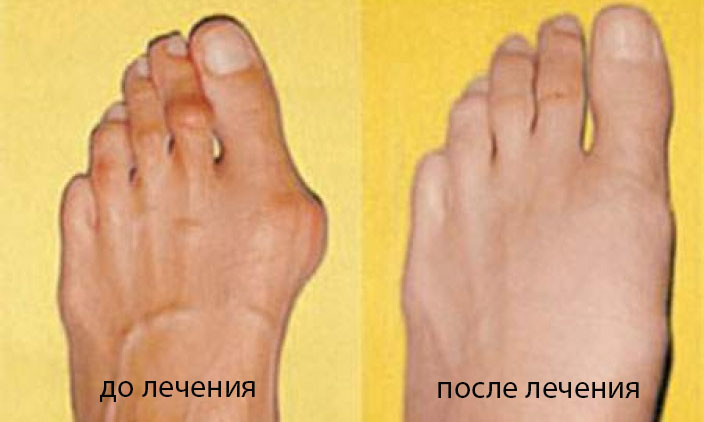 Valgusnaya deformatsiya 2