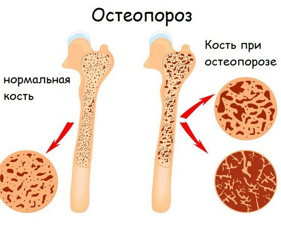 анализы osteoporoz analiz