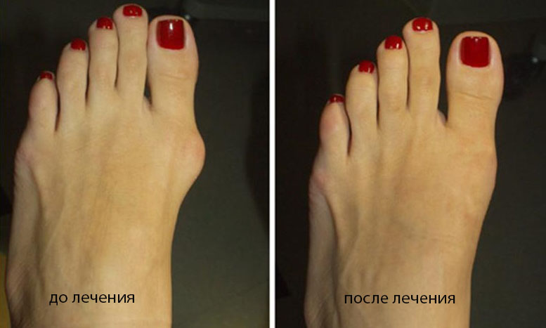 valgusnaya deformatsiya 1